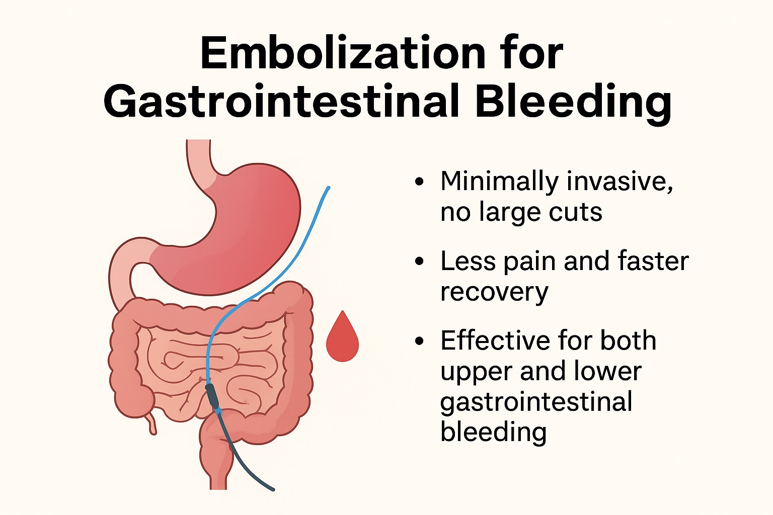 Embolization for Gastrointestinal Bleeding