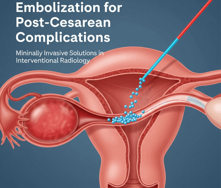 Embolization for Post-Cesarean