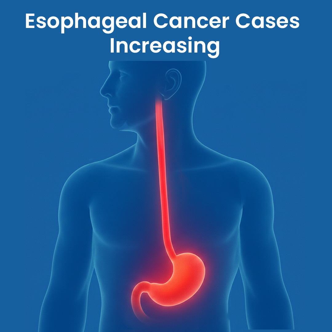 Esophageal Cancer