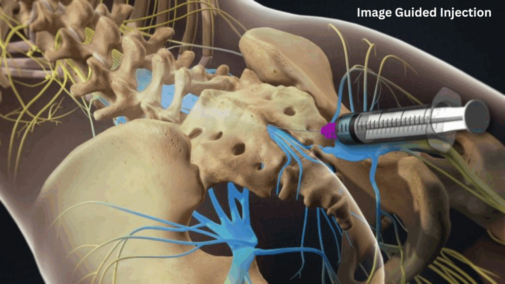 Osteoarthritis: 3D medical illustration showing an image-guided injection into the lower spine and sacrum area, highlighting nerves, bones, and targeted injection site for pain management.
