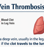 Deep Vein Thrombosis