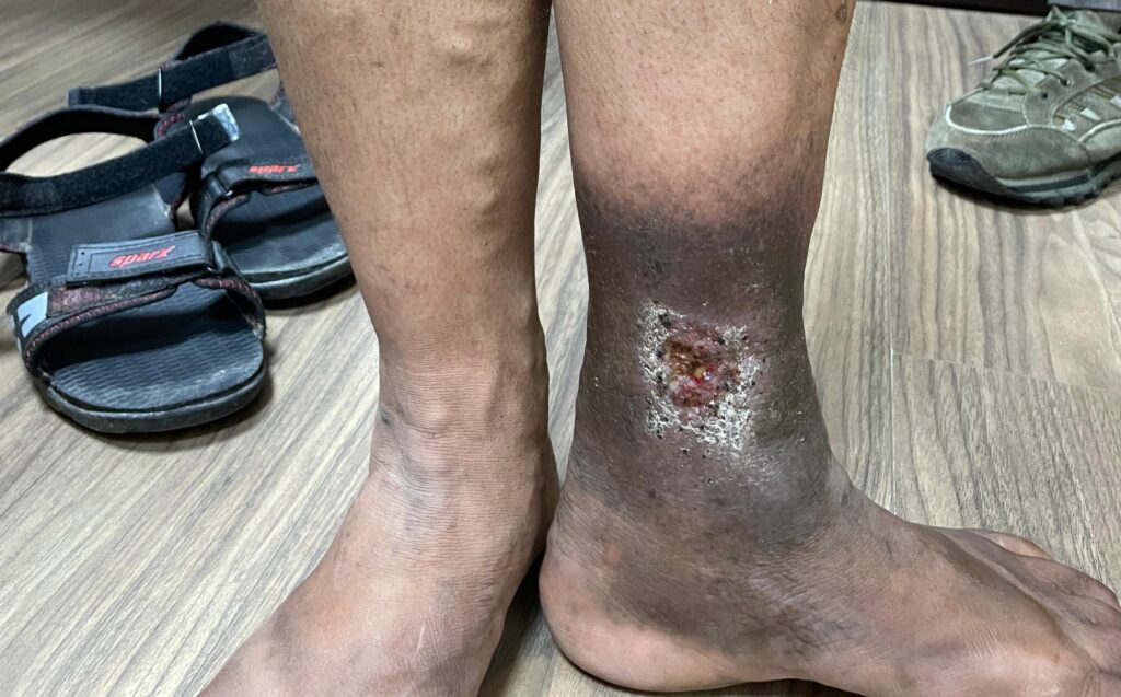 Varicose Veins and Venous Ulcers