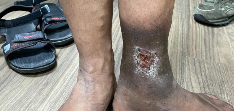 Varicose Veins and Venous Ulcers