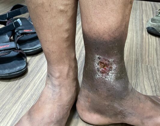 Varicose Veins and Venous Ulcers