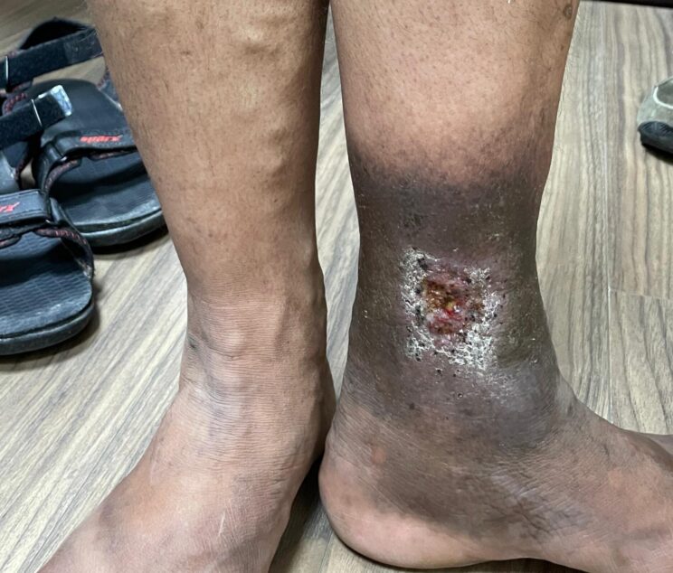 Varicose Veins and Venous Ulcers
