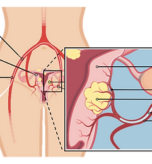 Uterine Artery Embolization