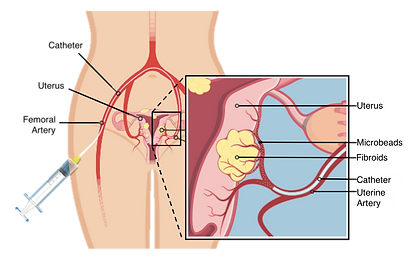 Uterine Artery Embolization