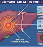 microwave ablation